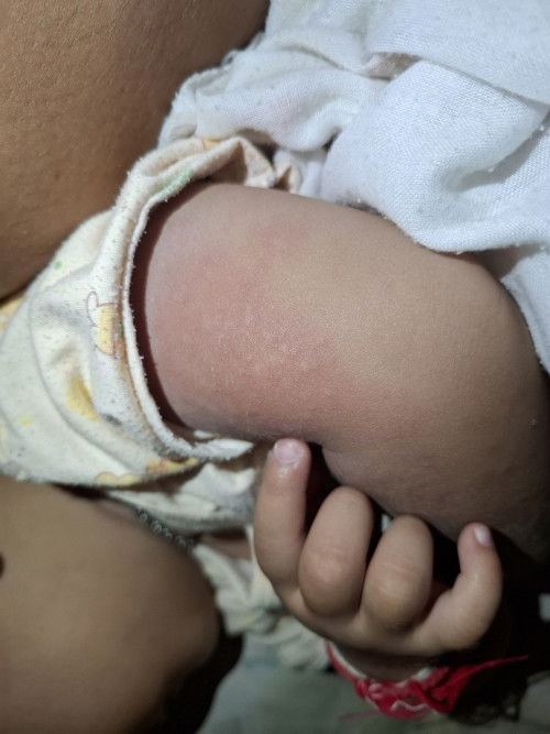 น้องได้1ขวบคะแต่อยู่ๆผื่นก้ขึ้น