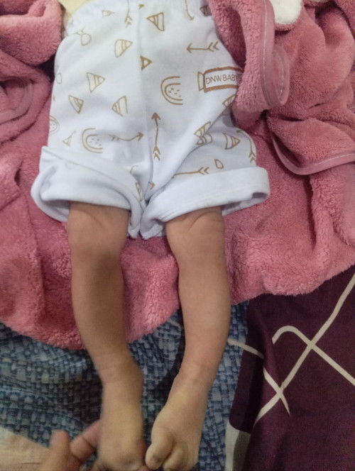 Kaki Bayi Tulangnya Bengkok