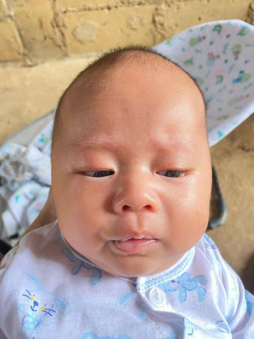 กระหม่อมบวม
