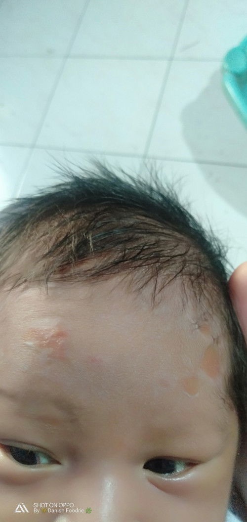Ruam kening bayi, pakai apa yaa?