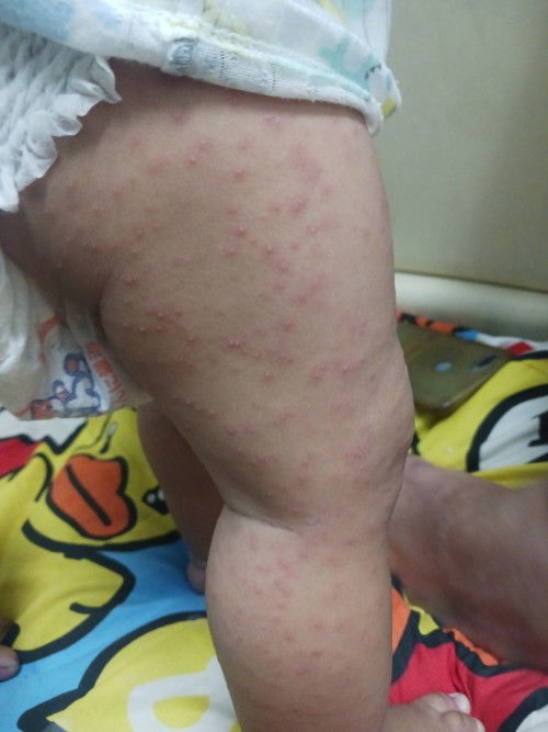 ผื่นแบบนี้ผื่นภูมิแพ้ไหม
