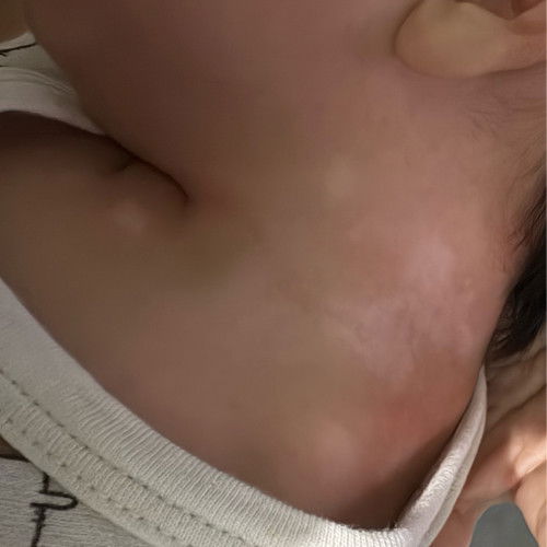 Ano po kaya yan white na yan sa neck ng baby ko ?