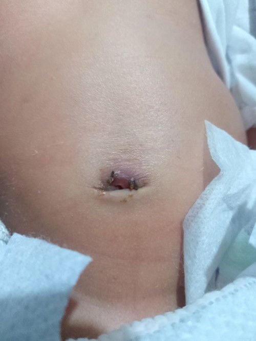 Normal lang po ba pusod ni baby??