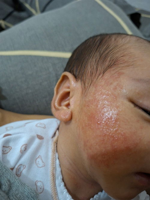 Beruntusan merah di wajah bayi, solusinya apa ya moms?