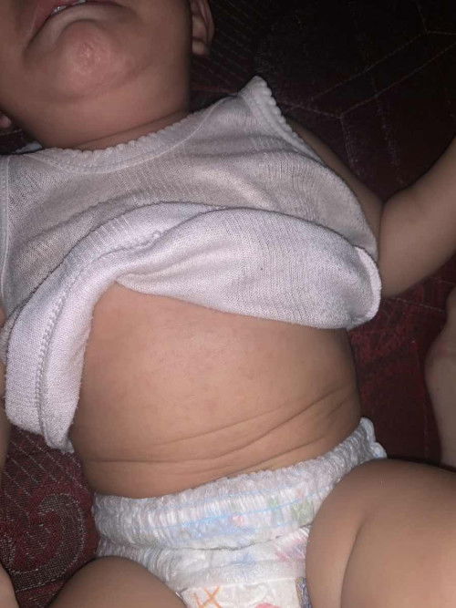 demam dan muncul bintik
