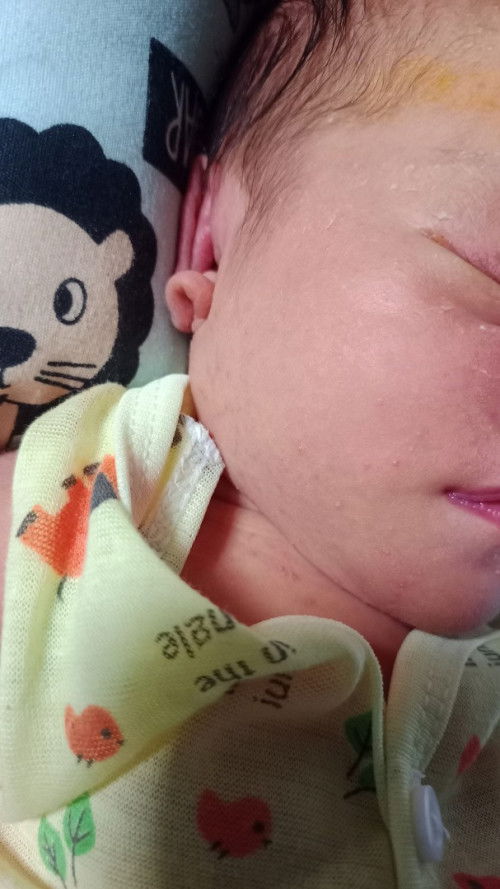 Ruam kulit Newborn