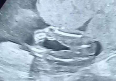 Gender baby