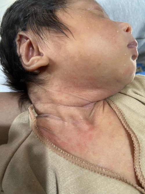 RUAM DI LEHER BAYI