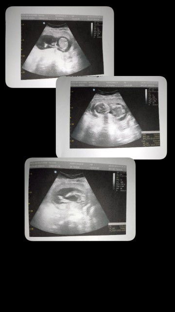 kemarin usg 17week sdh keliatan bayinya bun , alhamdlh detak jntung normal bb janin 197gram