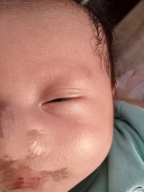 Bintik pada bayi