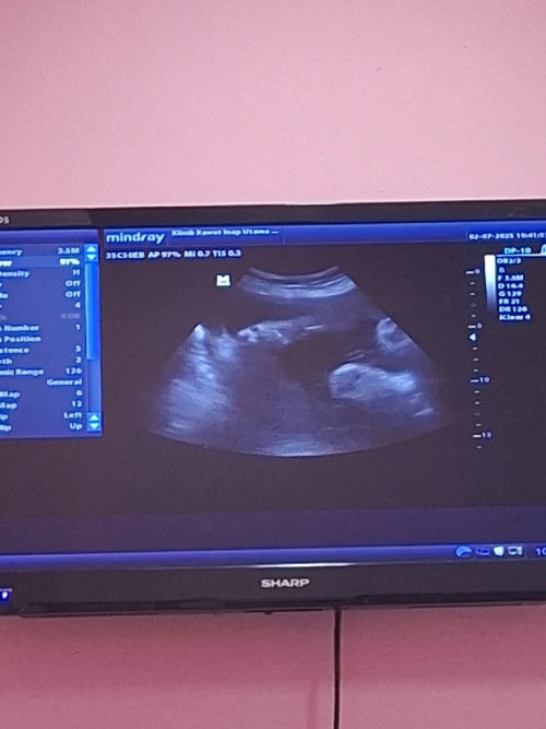 Dahak di kehamilan hingga 9 bulan