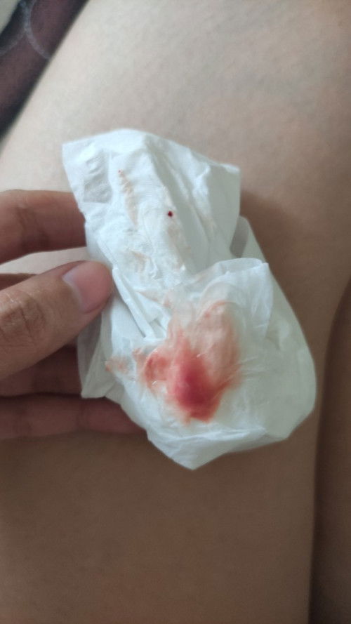 Keluar darah di usia kandungan 11 week