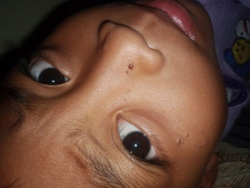 Kutil di hidung