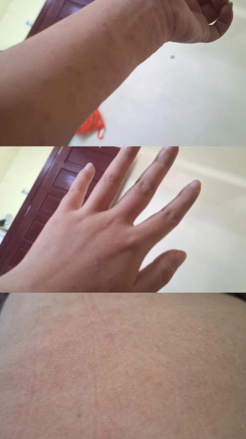 Di sini ad yang alami semua badan pada gatal bintik ruam seperti di gigit serangga