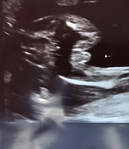 gender reveal
