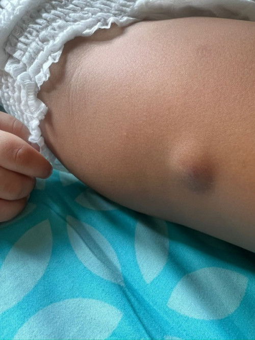 Bun,,,,saya newmom..mau tanya...anak saya pahanya benjol semenjak dpt ...
