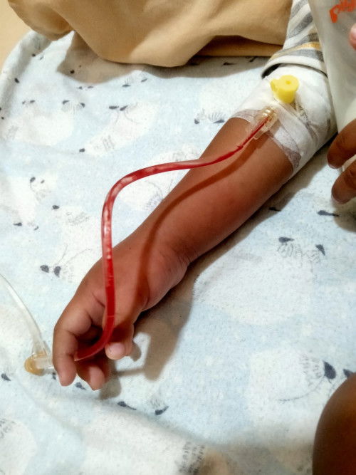Bekas Infus bengkak