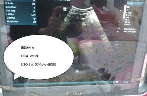 Hasil USG Kehamilan 11w Tidak Jelas