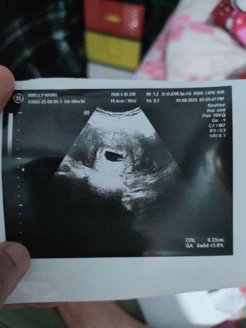 Hamil anak 2 kehamilan 6 Minggu