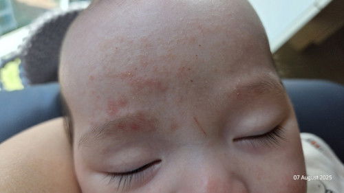 Red dry patch