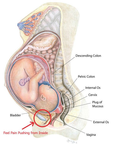 36w 5days อาการปวดบีบเป็นพักๆคืออะไีร