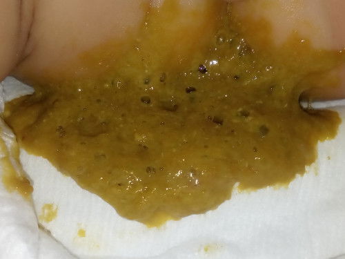Related to Baby Poop 4mos with 2 teeth already