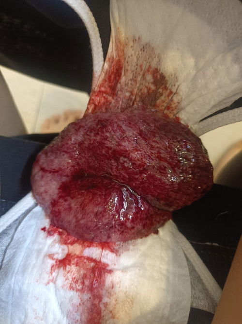 ก้อนเนื้อออกมาก้อนใหญ่