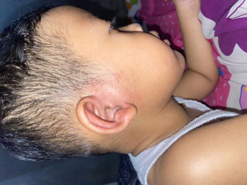 Lagi sedih karna telinga anak tiba tiba bintik merah. Udah dikasih salep zoralin tapi udah 5