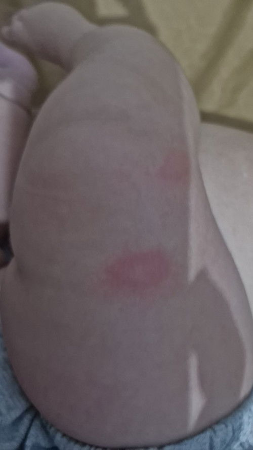 Ini penyebab gigitan apam