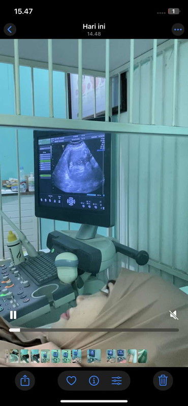 Hasil USG, bayi kecil, plasenta letaknya di bawah dan air ketuban kurang