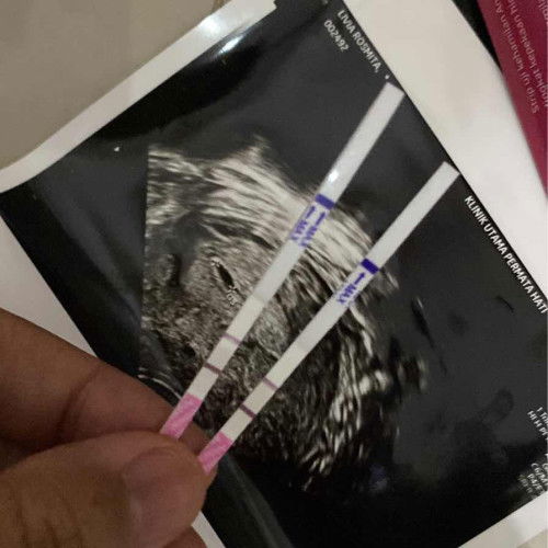 Hamil jadi pelupa