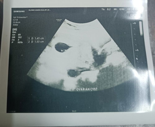 Cyst ketika mengandung
