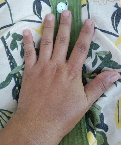 natural lng po ba na gnito ung kamay panrang namamaga, 35weeks npo ako,.