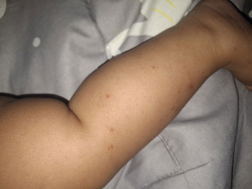 Muncul bintik merah pada kulit bayi