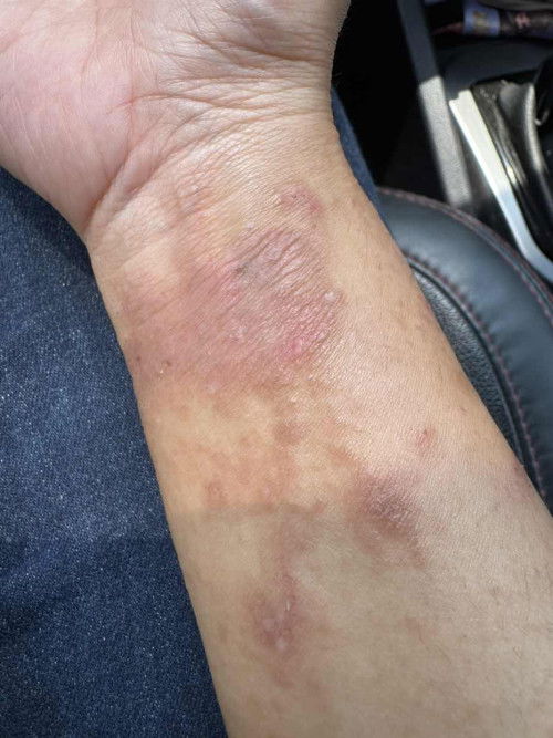 alahan / eczema