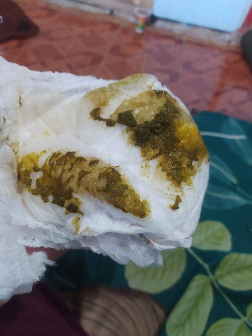 Ini pup anak aku usia 5 bulan 29 hari,apakah normal?