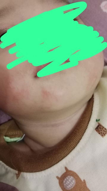 Masalah kulit si kecil