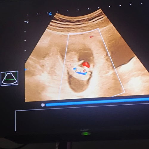 Usg kehamilan 10w HPL MARET