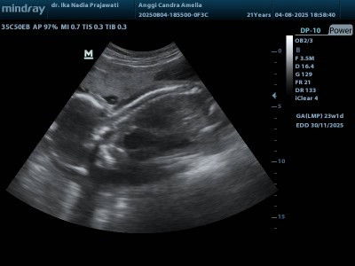 usia kehamilan 23 week