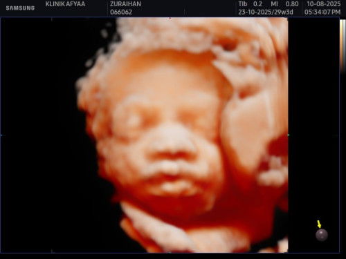 Scan 5D muka baby