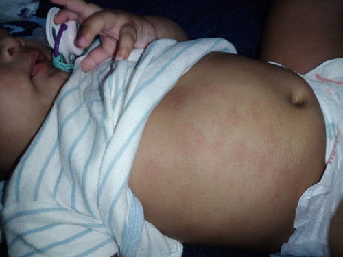Hi nak tanya pengamalan korang ,ni ruam ke sebab ada tukar susu frisolac atau ni penyakit eczema