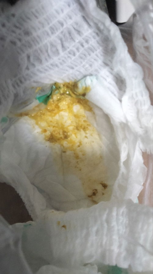 Pup sehari 10 kali apakah normal Bun tapi tidak disertai demam, aku coba gak pakein Pampers krn ruam