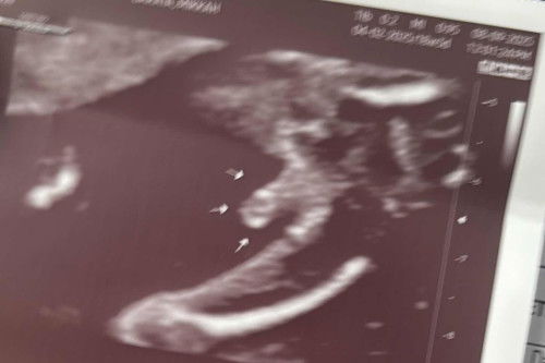 18 weeks ultrasound gemder