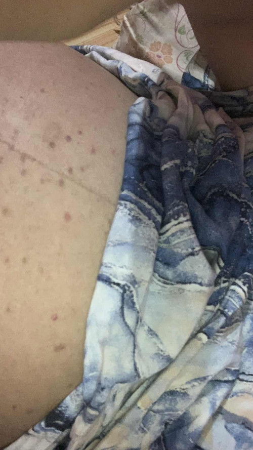 perut kena bentol" seperti jerawat