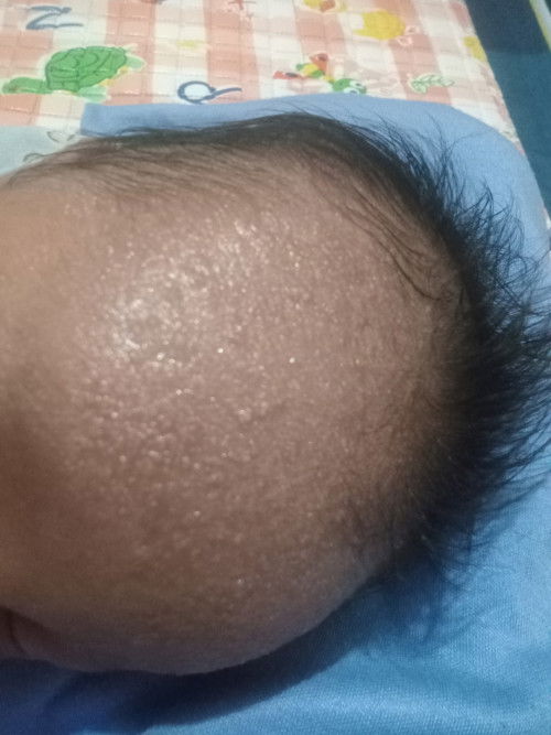 Obat untuk biang keringat