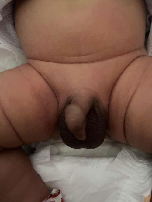 Penis anak bengkok