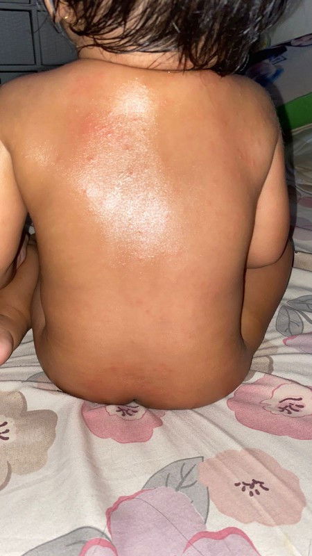 Beruntusan pada anak 1 tahun