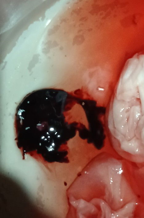 Hi Mommies! Ask lang po sana if normal po ba na ganito po kalaki na dugo? May menstruation po ako.