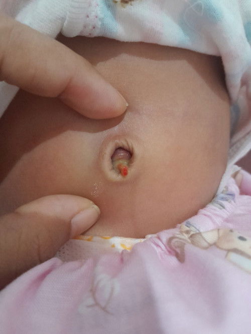 Tali pusat puput karena ketarik
