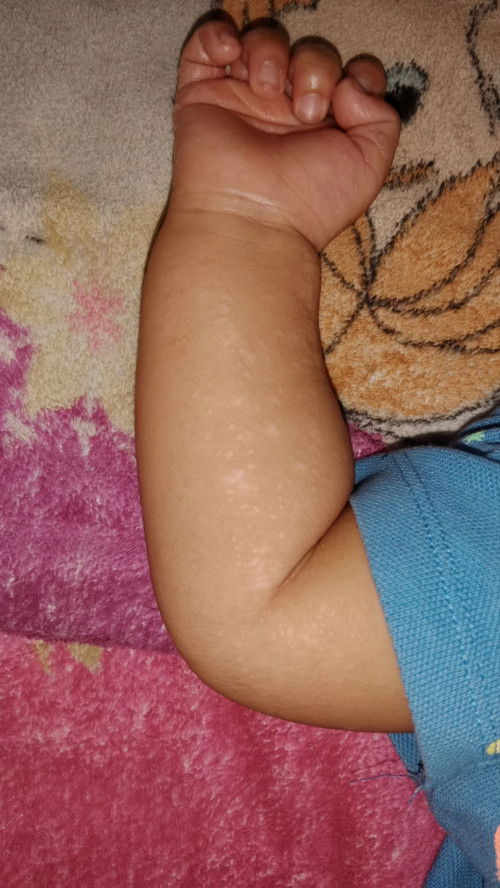 Kulit anak bayi seperti ini solusinya gimana ya bun, dari 3 bulan smpai skrg mau 5 bulan